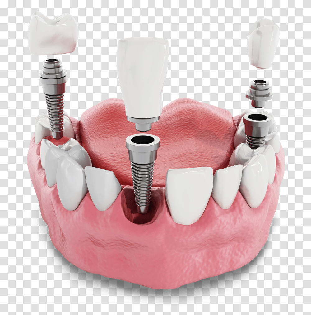 Dental Implant Model Kansas City Mo Implant Dentar Pret, Birthday Cake, Dessert, Food, Jaw Transparent Png