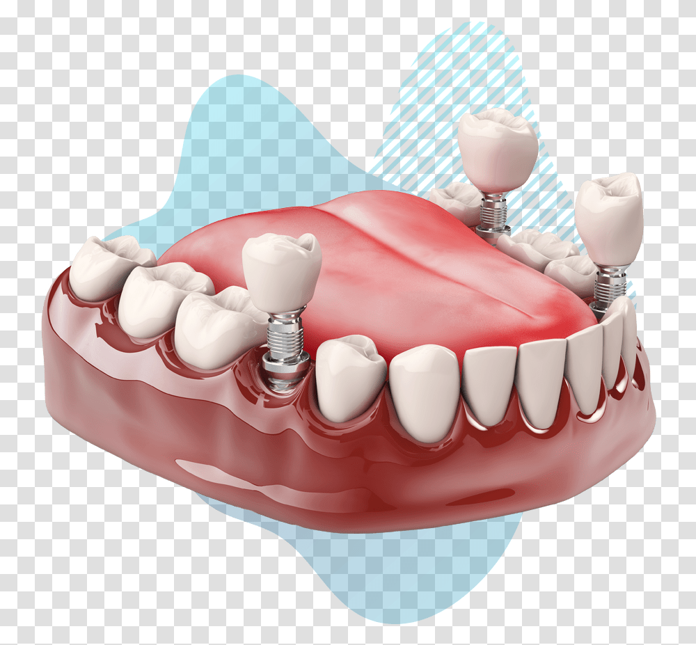 Dental Implant Model Pasang Gigi Palsu Geraham, Jaw, Teeth, Mouth, Lip Transparent Png