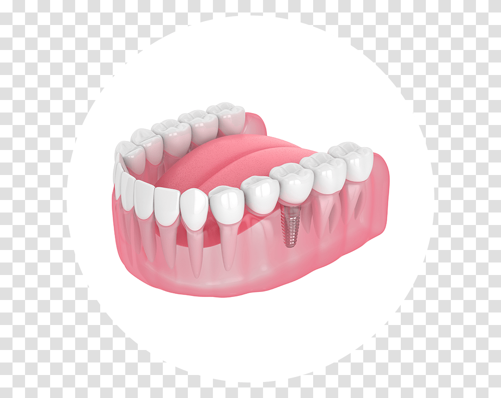 Dental Implant, Teeth, Mouth, Lip, Jaw Transparent Png