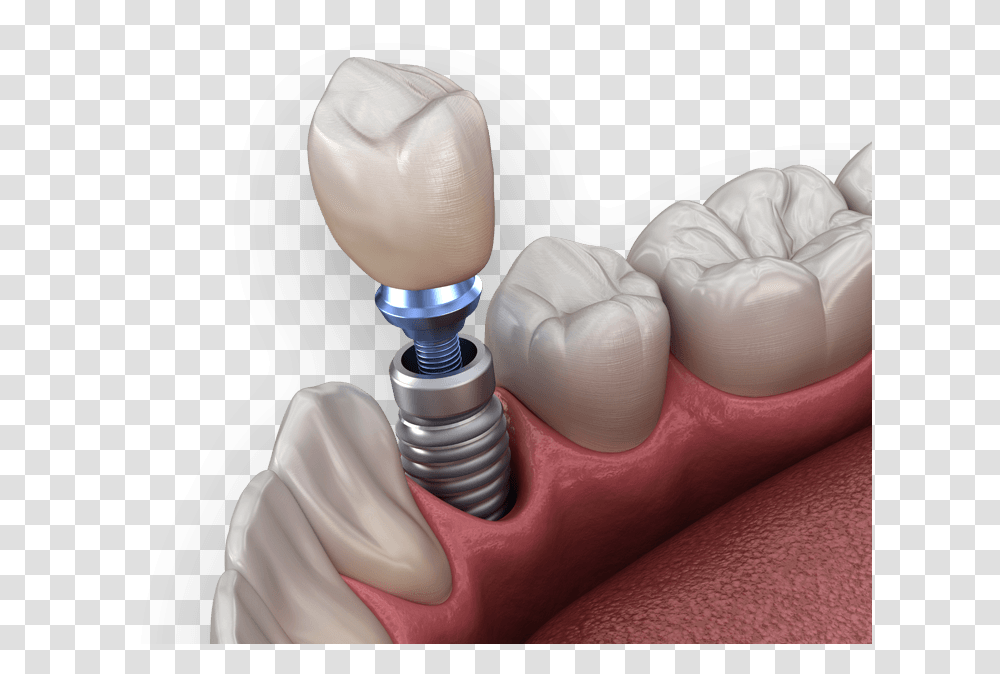 Dental Implants Implant Dental, Person, Human, Machine, Hand Transparent Png