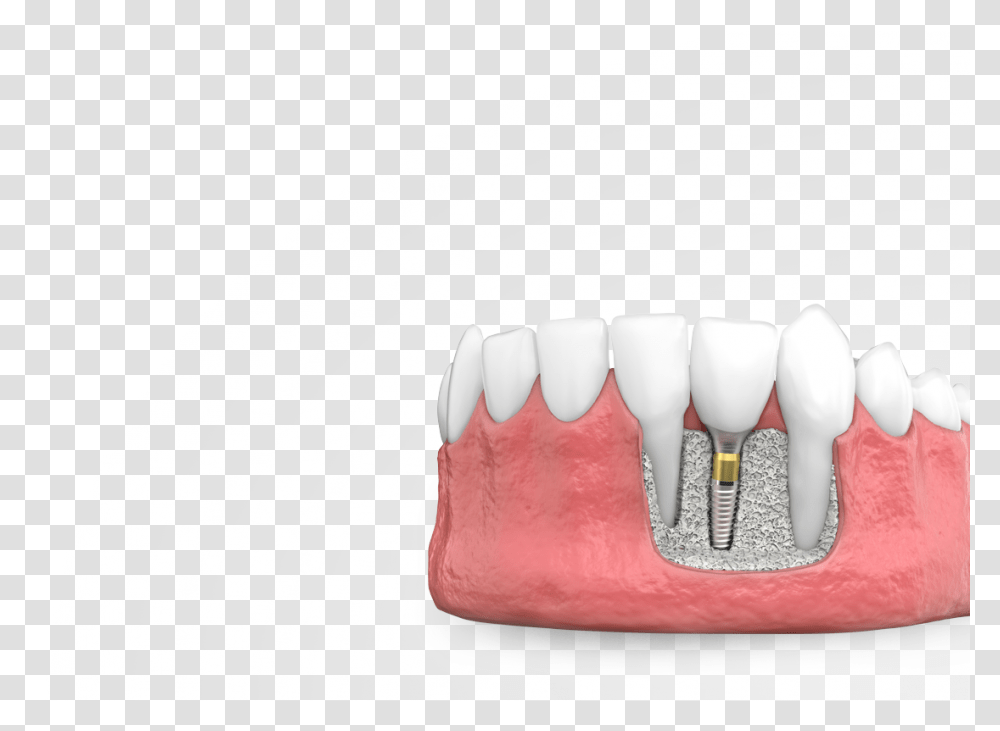 Dental Implants Marking Tools, Teeth, Mouth, Lip, Jaw Transparent Png