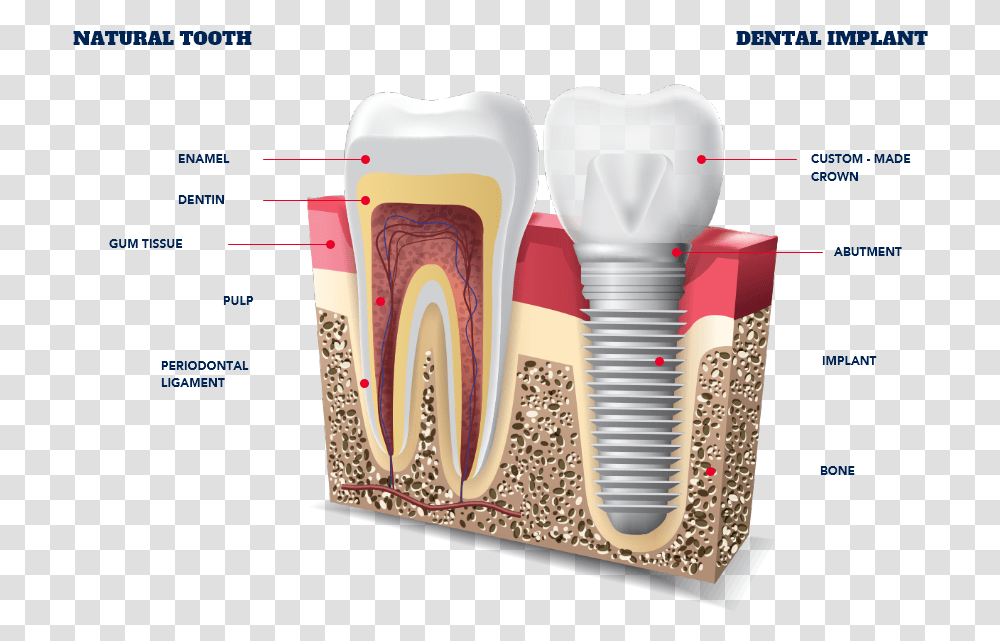 Dental Implants Types Getting New Teeth All Dental Implants In Jawbone, Light, Graphics, Art, Lightbulb Transparent Png