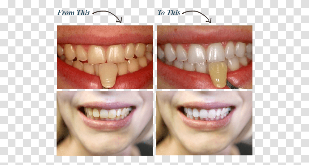 Dentistrytooth Bodypersonal Carelaughdentistry Can I Get My Teeth White, Mouth, Lip, Human Transparent Png