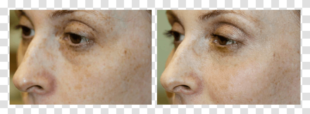 Dermal Filler Freckle, Face, Person, Human, Skin Transparent Png