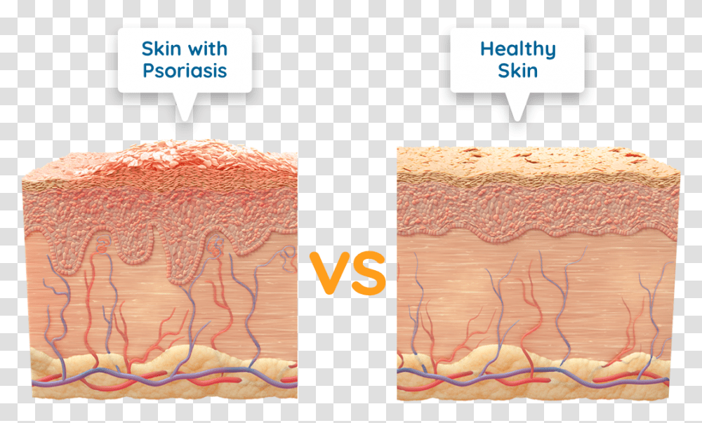 Diagram Of Skin With Psoriasis Vs Healthy Skin Psoriasis Dead Skin Cell, Rug, Advertisement, Poster Transparent Png