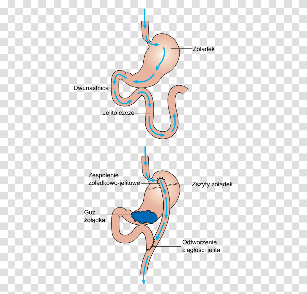 Diagram Showing Before And After Stomach Bypass Surgery, Snake, Reptile, Animal Transparent Png
