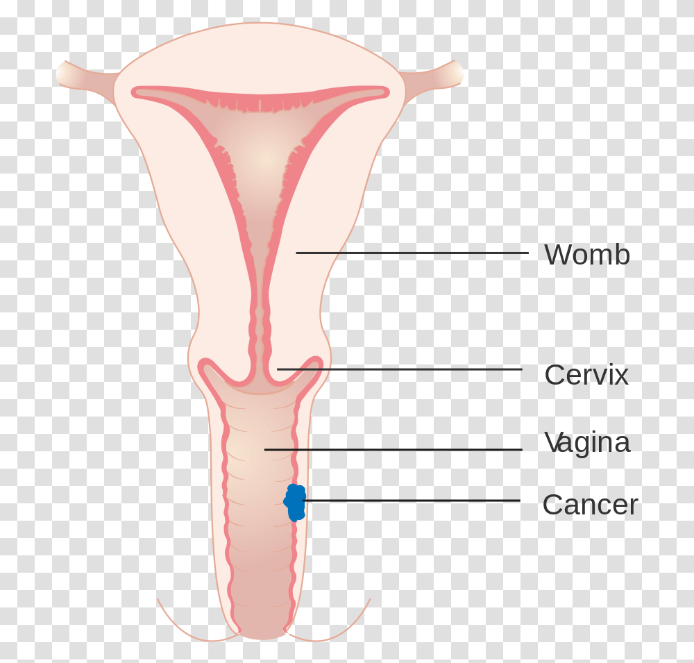 Diagram Showing Stage 1 Vaginal Cancer Cruk Symmetry, Blow Dryer, Appliance, Hair Drier, Hip Transparent Png