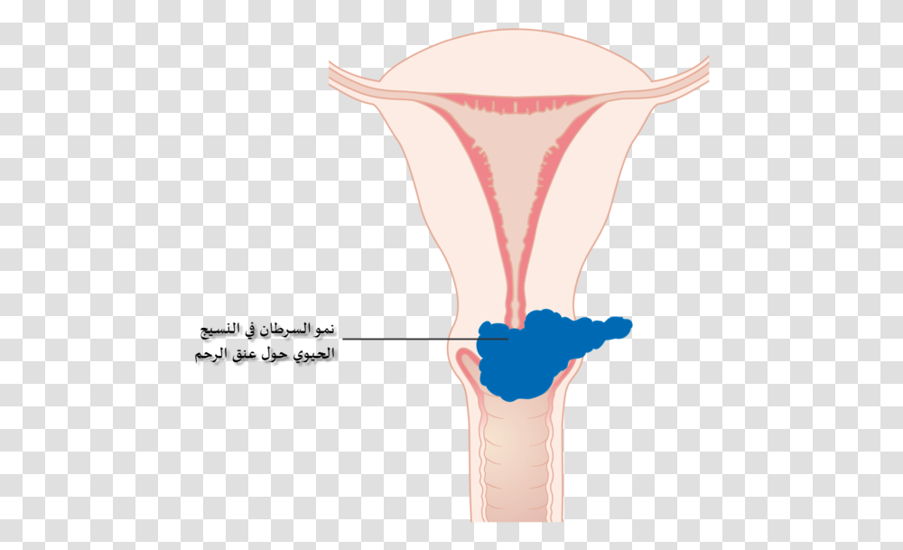 Diagram Showing Stage 2b Cervical Cancer Cruk 216 Ar Cervical Cancer, Bird, Animal, Plot, Beverage Transparent Png