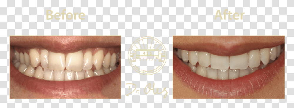 Diagram, Teeth, Mouth, Lip, Person Transparent Png