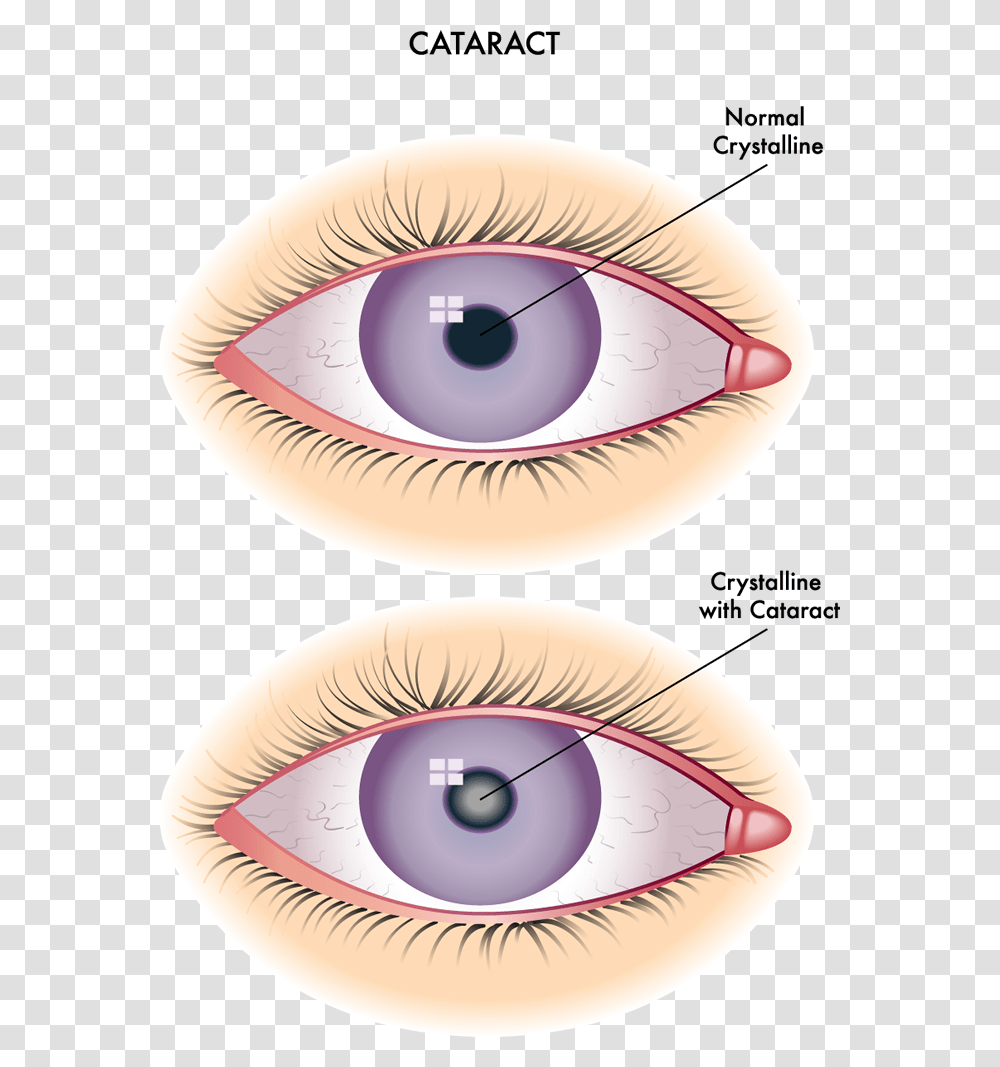 Difference Between Cataract And Corneal Opacity, Contact Lens, Clam, Seashell, Invertebrate Transparent Png