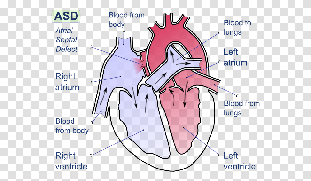 Difference Between Left And Right Side Of Heart Fig Atrial Septal Defect, Poster, Plot, Diagram, Sea Life Transparent Png