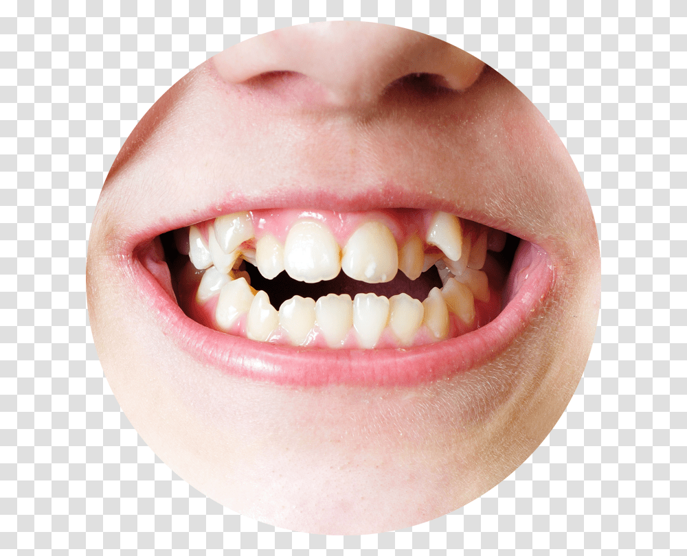 Do Teeth Grow Crooked Irregular Teeth, Mouth, Lip, Jaw, Person Transparent Png