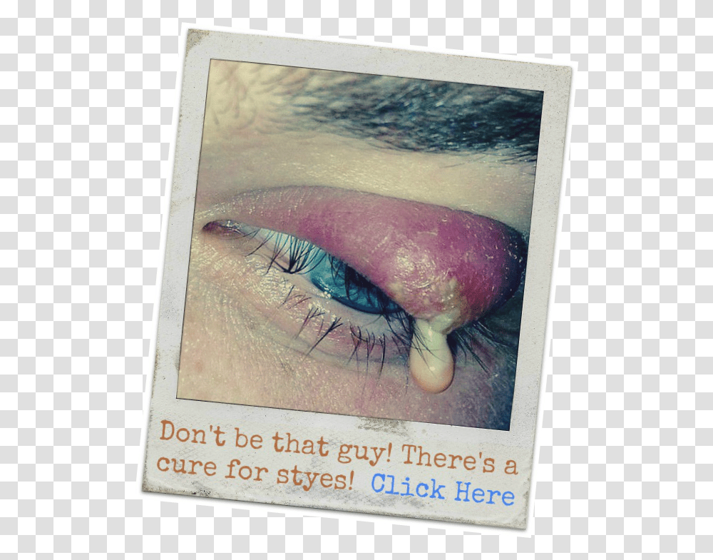 Does Putting A Tea Bag On Eyes Get Rid Of Styes Warm Compress, Advertisement, Poster, Contact Lens, Fish Transparent Png