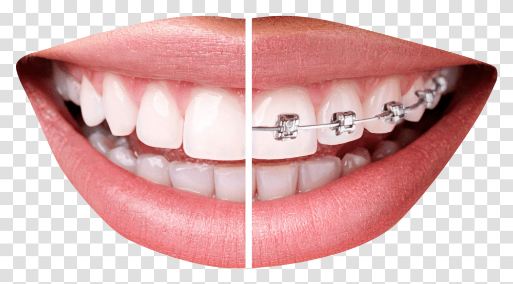 Download Free Teeth With Braces Tooth Braces, Mouth, Lip, Person, Human Transparent Png