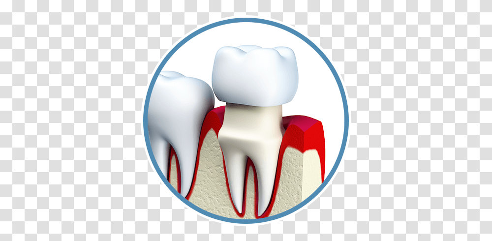 Download Hd Dental Crowns Tooth Porcelain Figure Tooth Crown Fell Out, Cutlery, Fork, Mouse, Hardware Transparent Png