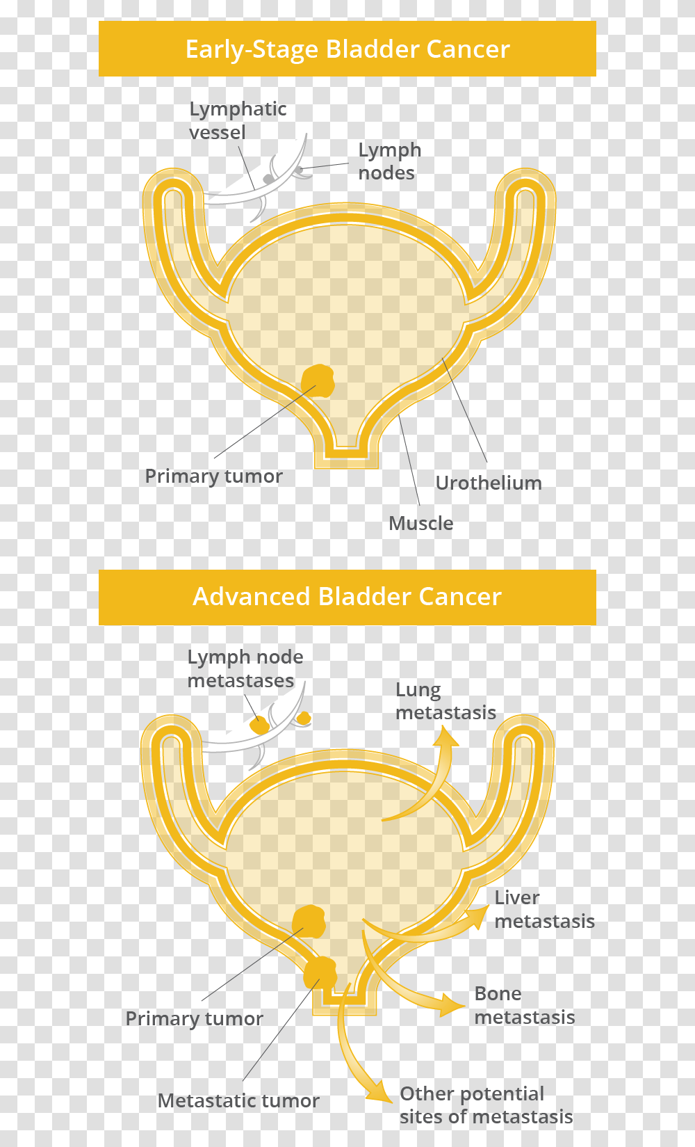 Early Stage Bladder Cancer Showing Little Spread Vs Illustration, Advertisement, Poster, Outdoors Transparent Png