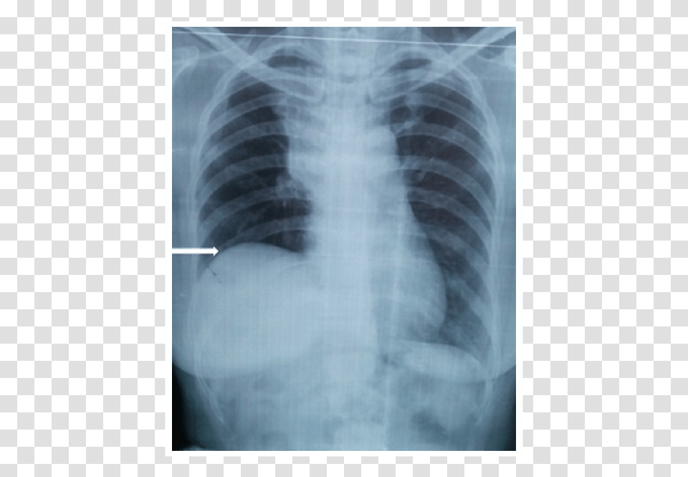 Elevated Right Hemidiaphragm X Ray, X-Ray, Medical Imaging X-Ray Film, Ct Scan Transparent Png