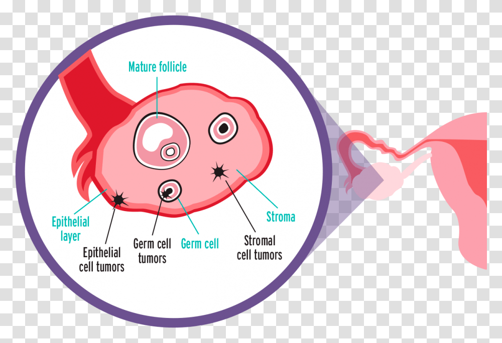 Epithelial Ovarian Cancer, Diagram, Plot, Ear Transparent Png