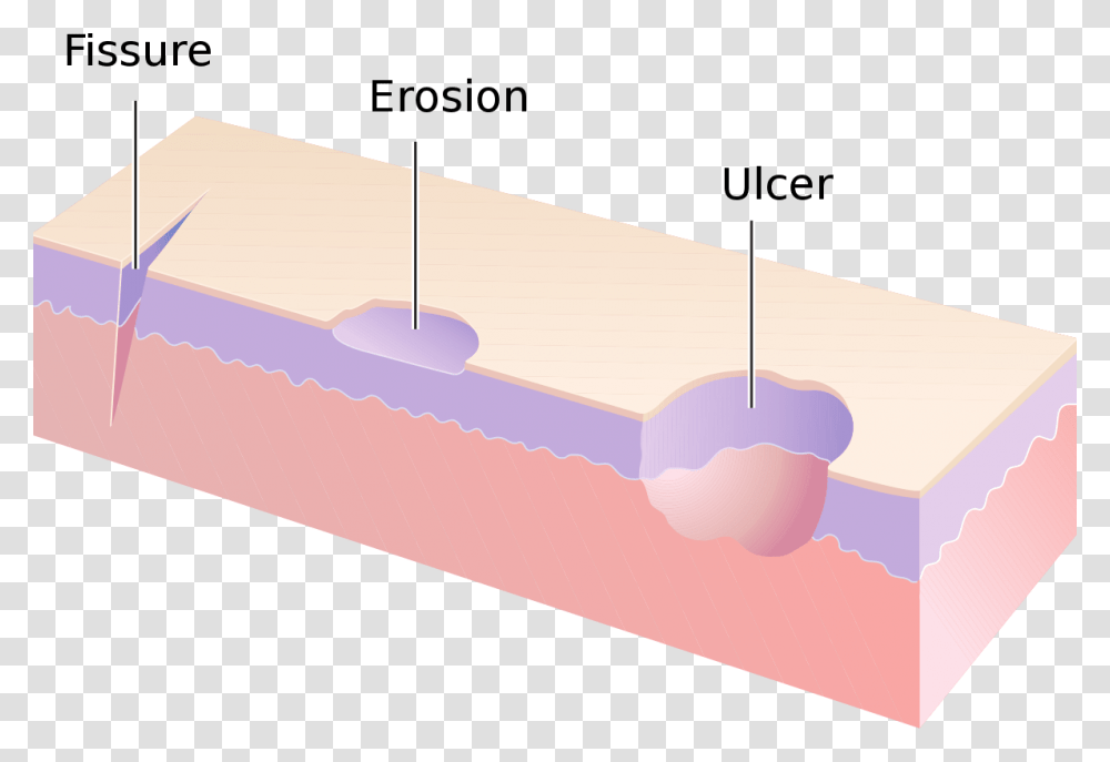Erosion And Ulcer Difference, Wood, Plywood Transparent Png