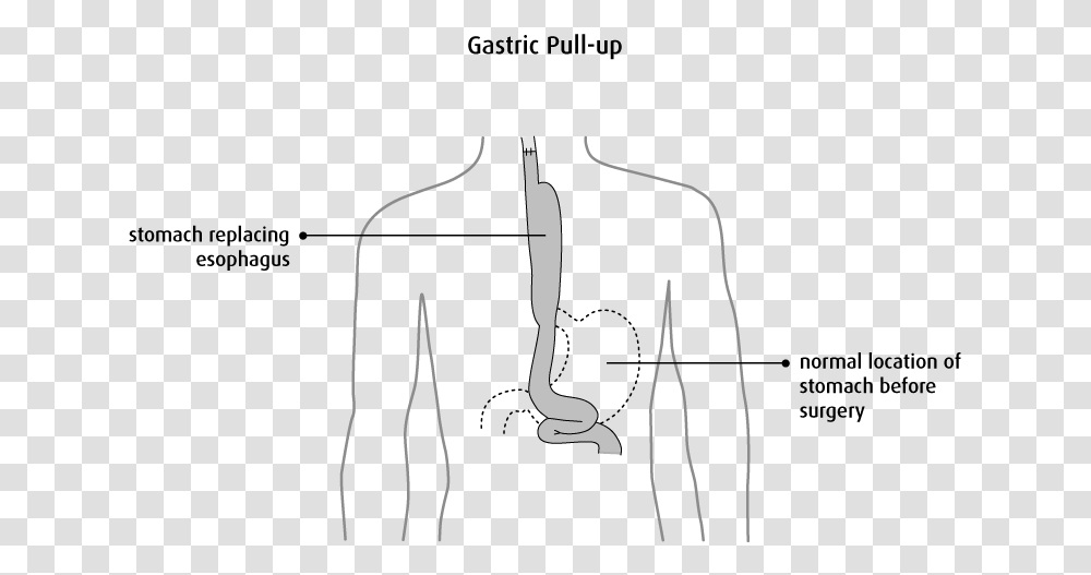 Esophageal Cancer Gastric Pull Up, Fork, Cutlery, Steamer, Zebra Transparent Png