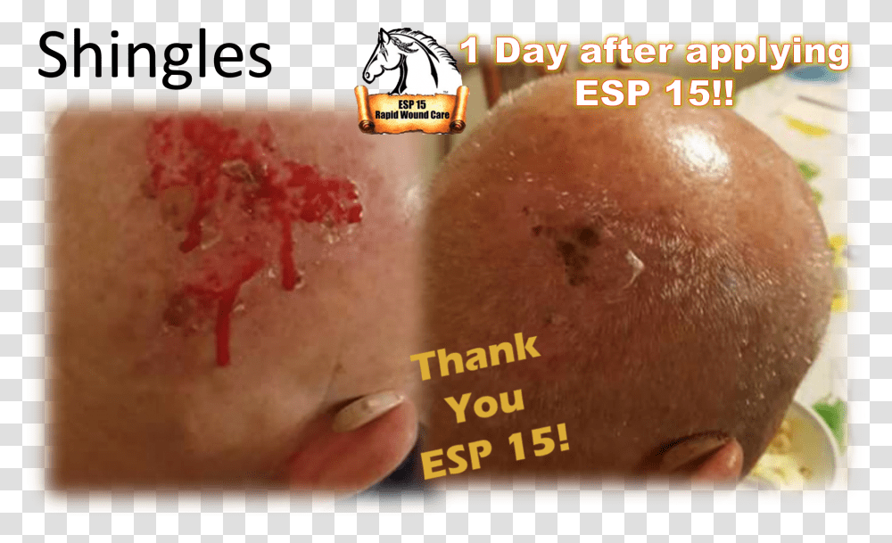 Esp 15 Used On Shingles On The Back Of A Man's Head Bun, Skin, Injury, Shoulder, Knee Transparent Png