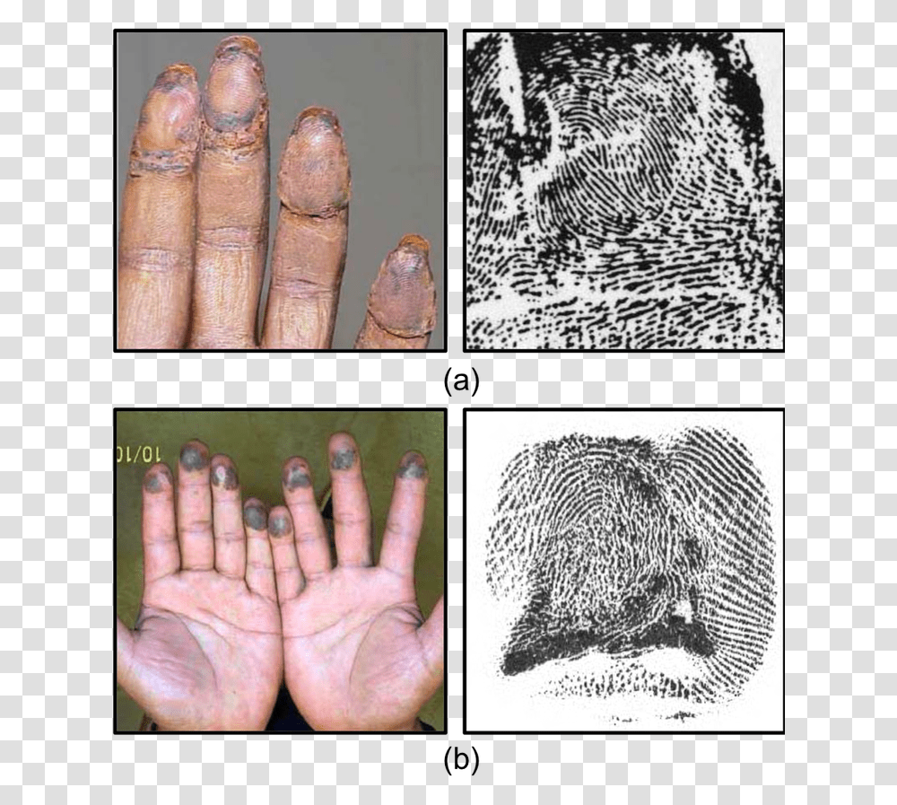 Example Images Of Altered Fingerprints Fingerprint Alteration, Person, Human, Collage, Poster Transparent Png