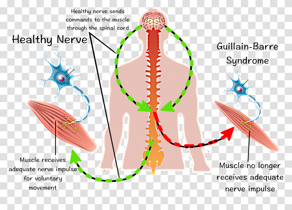 Exercise Guillain Barre Syndrome, Plot, Diagram Transparent Png