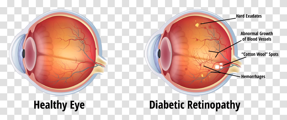 Eye During Diabetic Retinopathy, Sphere, Electronics, Astronomy, Outer Space Transparent Png