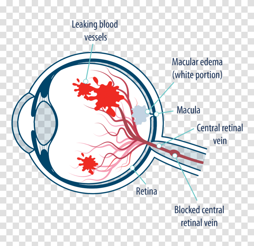 Eye With Macular Edema Following Retinal Vein Occlusion, Sphere, Diagram, Outdoors Transparent Png