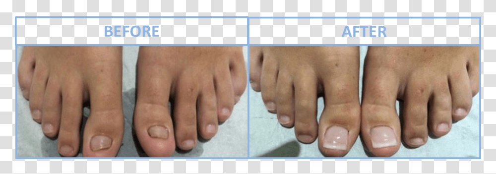 Fingernail Toe Nail Reconstruction Surgery, Person, Human Transparent Png