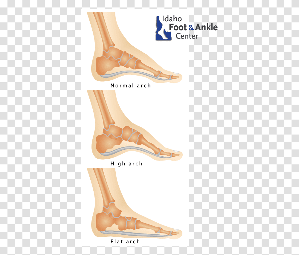 Flat Feet Amp Other Foot Deformities Fallen Foot Arch, Hip, Ankle, Neck, Hand Transparent Png