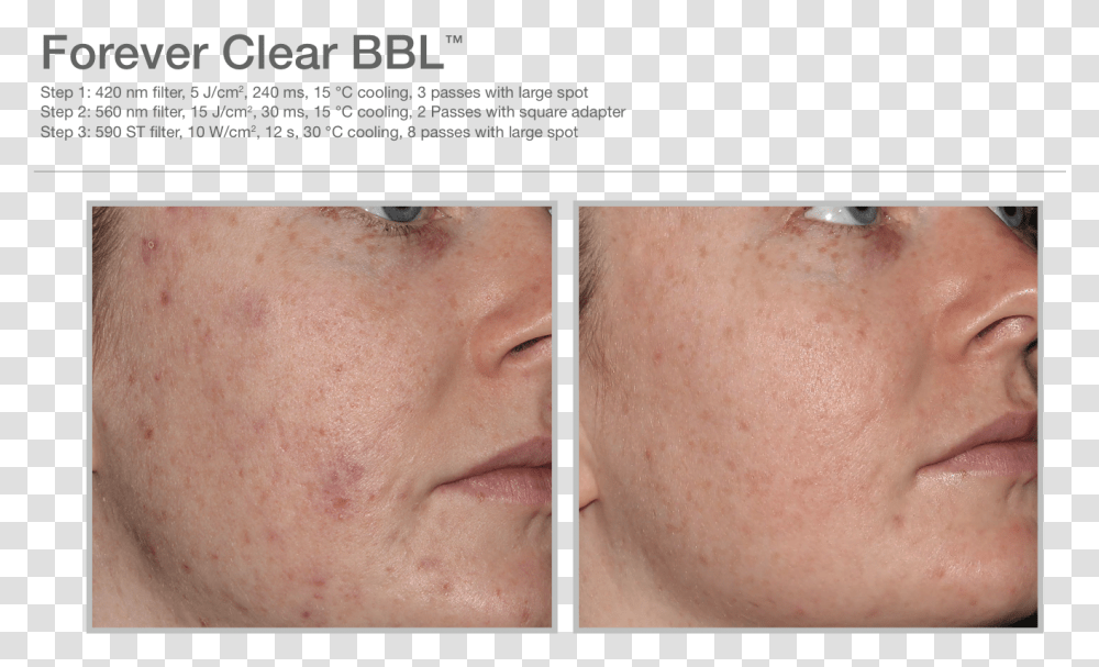 Forever Clear Bbl Before And After, Face, Person, Human, Skin Transparent Png