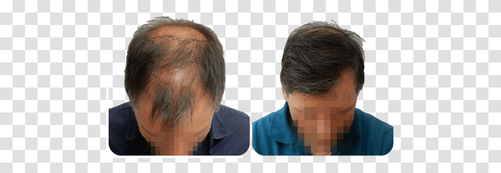 Fue Hair Transplant Procedure Advantages And Cost By Fue Hair Transplant Results, Person, Audience, Crowd, Face Transparent Png