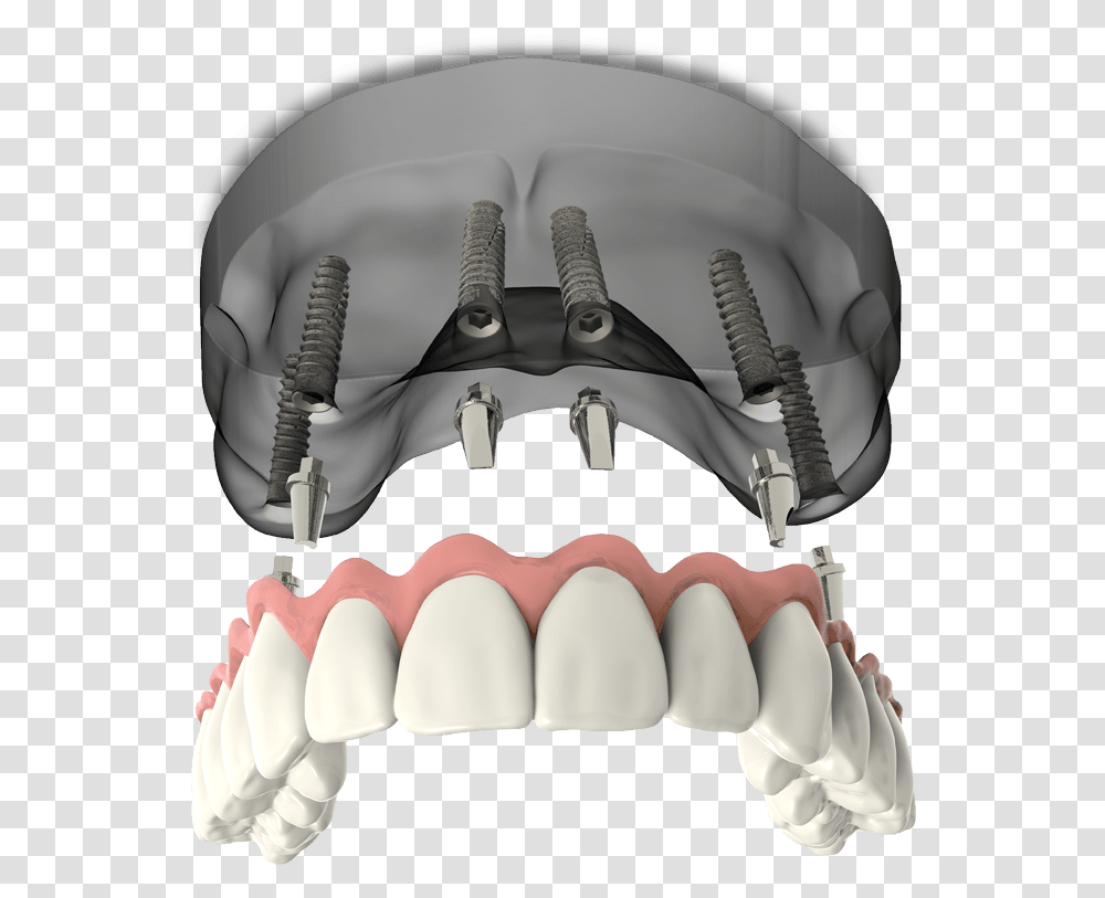 Full Arch Dental Implants Model Falls Church Va Bicycle Pedal, Jaw, Teeth, Mouth, Lip Transparent Png