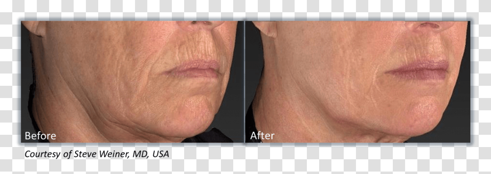 Genius Radio Frequency And Microneedling, Jaw, Neck, Person, Human Transparent Png