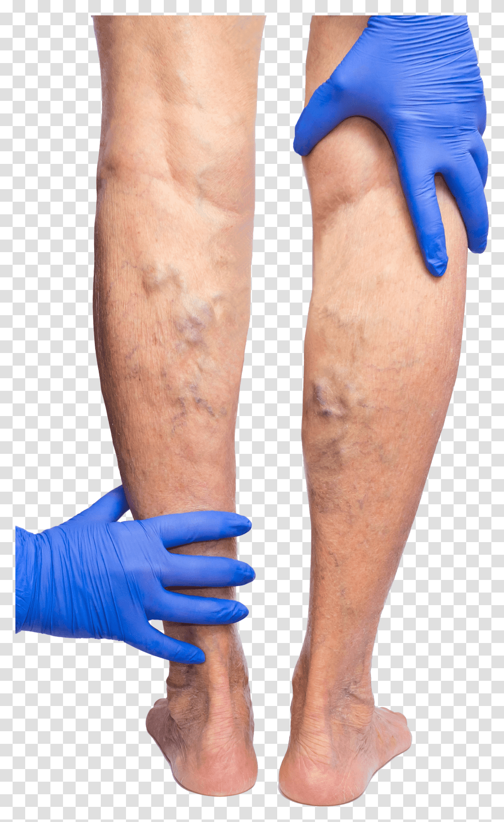 Gloved Hands Feeling The Backs Of Legs That Are Covered Phlebitis Varicose Veins, Arm, Person, Human, Knee Transparent Png