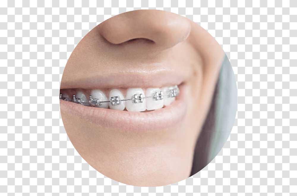 Goldstar Dental White Bands On Braces, Teeth, Mouth, Lip, Person Transparent Png