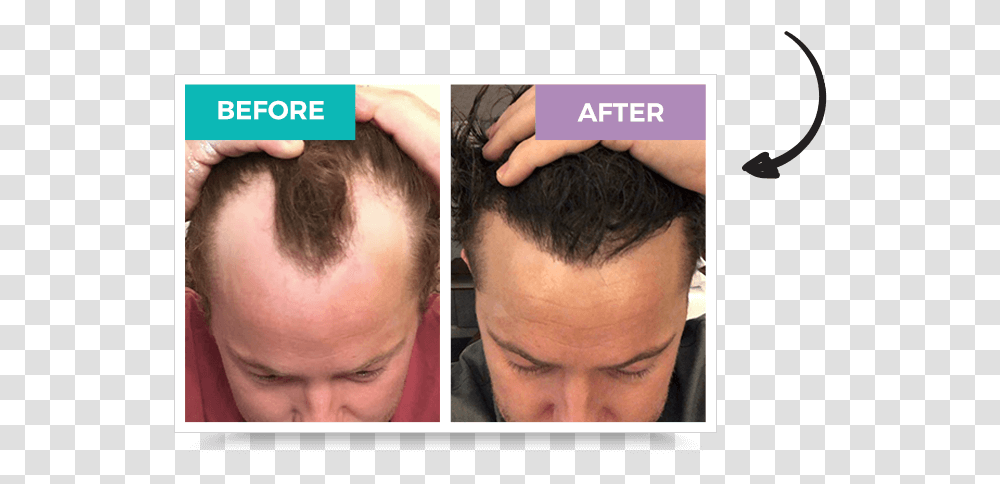 Hair Loss In Men And Women Could Stress Be The Cause Enm Long Does Hair Transplant Last, Face, Person, Head, Jaw Transparent Png