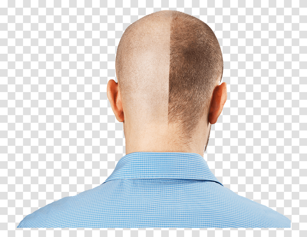 Hair Loss, Person, Human, Head, Shirt Transparent Png