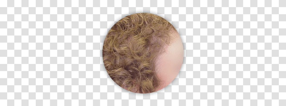 Hair Restoration San Diego Ca My Transplant Md Hair Design, Moon, Outer Space, Night, Astronomy Transparent Png