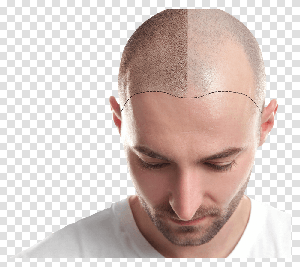 Hair Transplant In Ahmedabad Transplant Add Fue Hair, Head, Person, Face, Skin Transparent Png