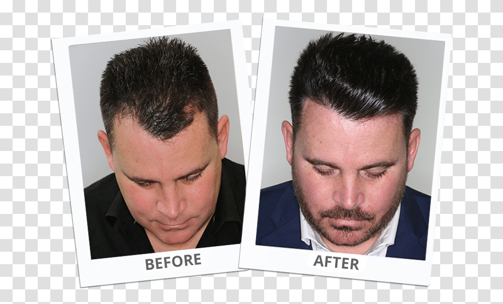 Hair Transplant Los Angeles, Head, Face, Person, Haircut Transparent Png