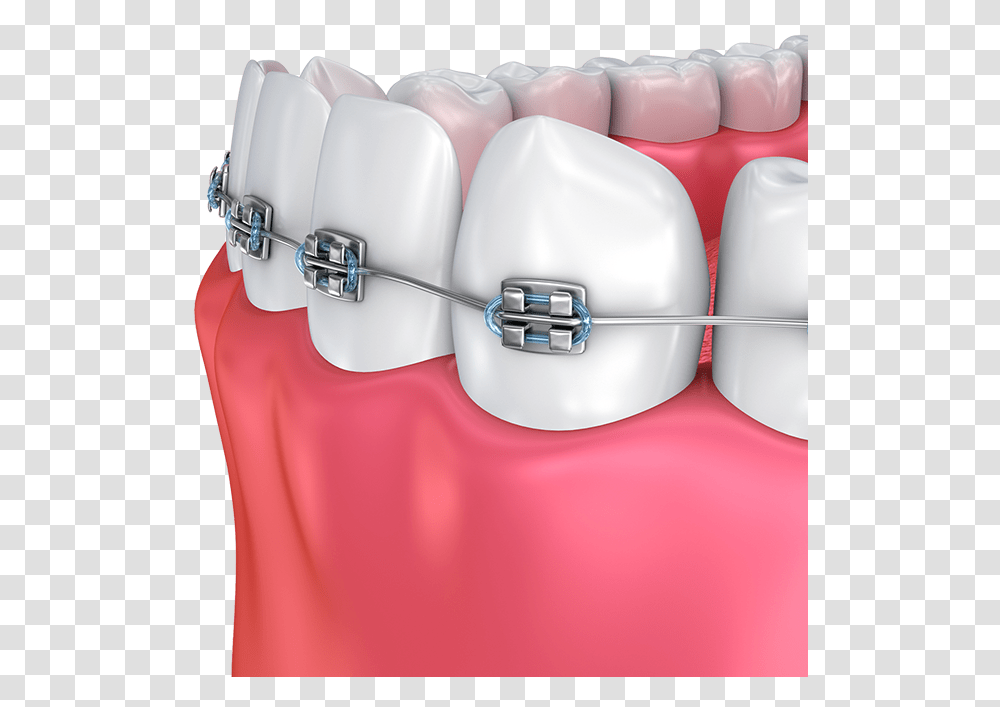 Haltom Orthodontics Dental Braces, Jaw, Teeth, Mouth, Lip Transparent Png