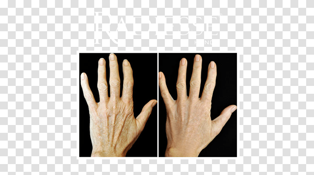 Hand Rejuvenation Peachtree City Ga Atlanta Ga, Person, Human, Wrist, Face Transparent Png