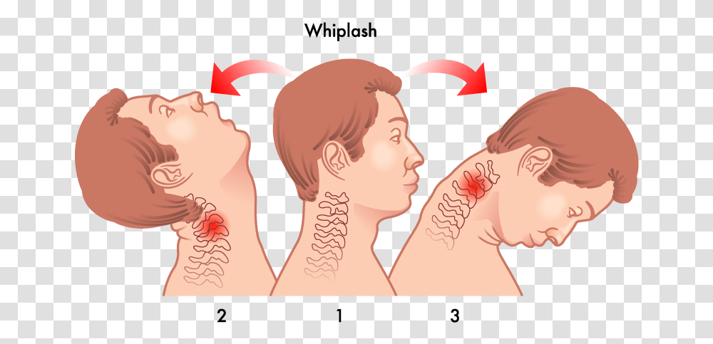 Head Neck Whiplash Whiplash Injury, Skin, Person, Face, Jaw Transparent Png