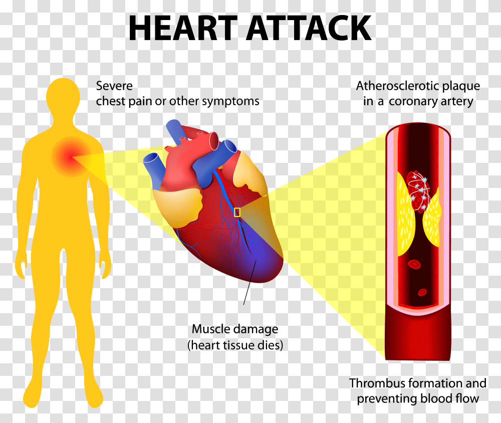Heart Attack2 Adobestock Heart Chest Pain, Beverage, Drink, Bottle, Alcohol Transparent Png