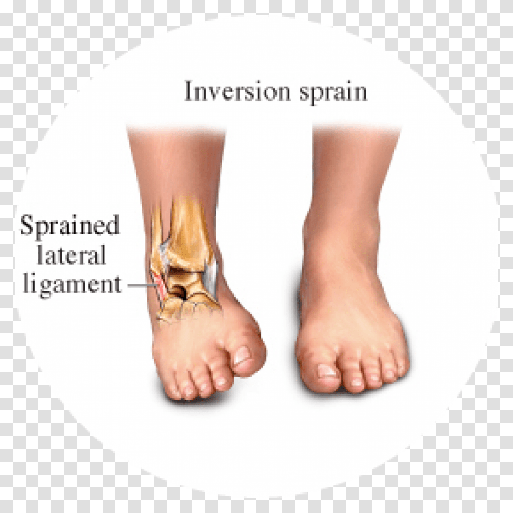 Hhg Inversion Vs Eversion Ankle Sprain, Heel, Toe, Person, Human Transparent Png