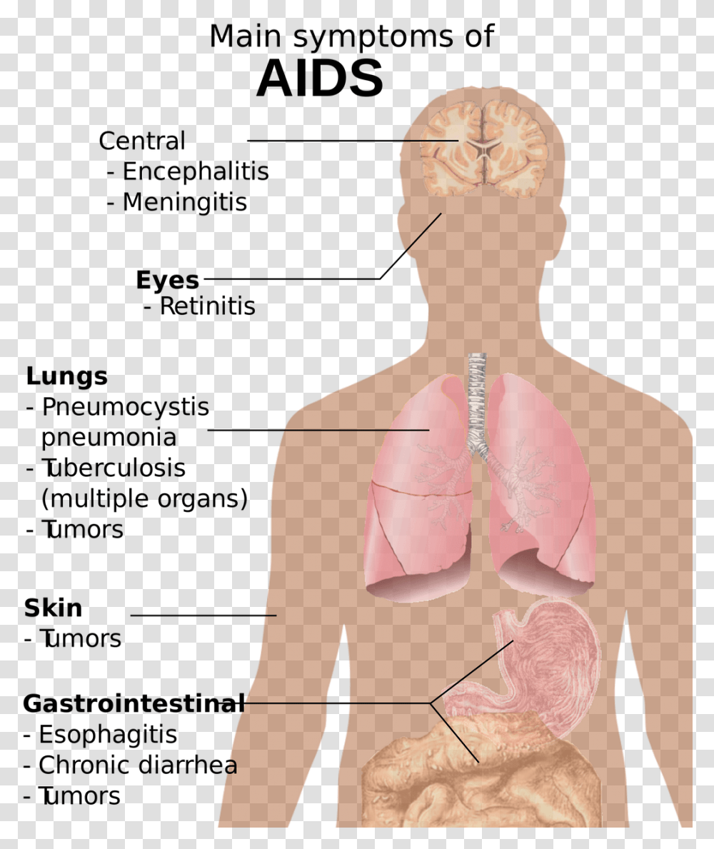Hiv Aids 2 2 Free Photo Main Symptoms Of Aids, Neck, Person, Human, Diagram Transparent Png