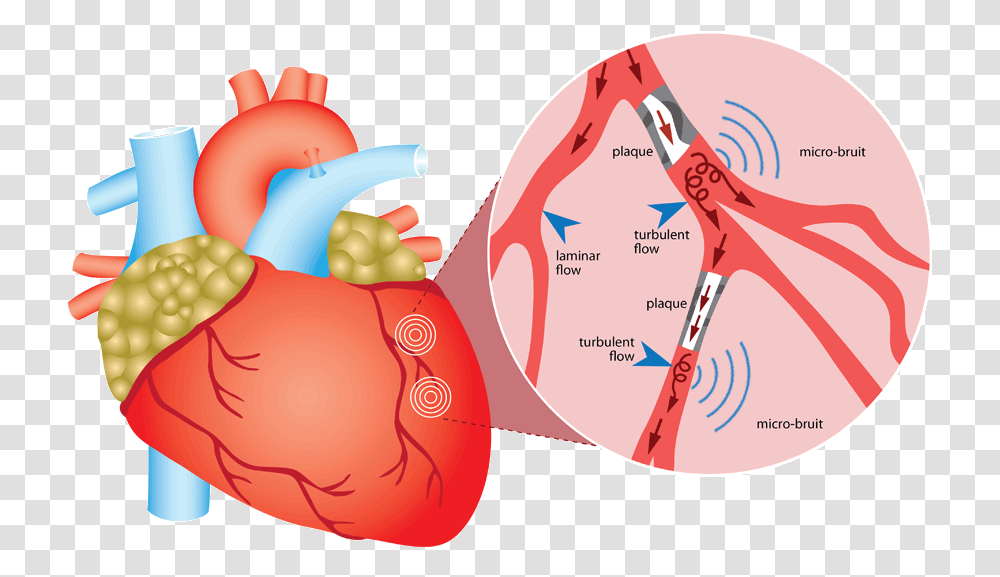 Home Ausculsciences Coronary Artery Disease Gif, Plot, Diagram, Shoulder, Neck Transparent Png