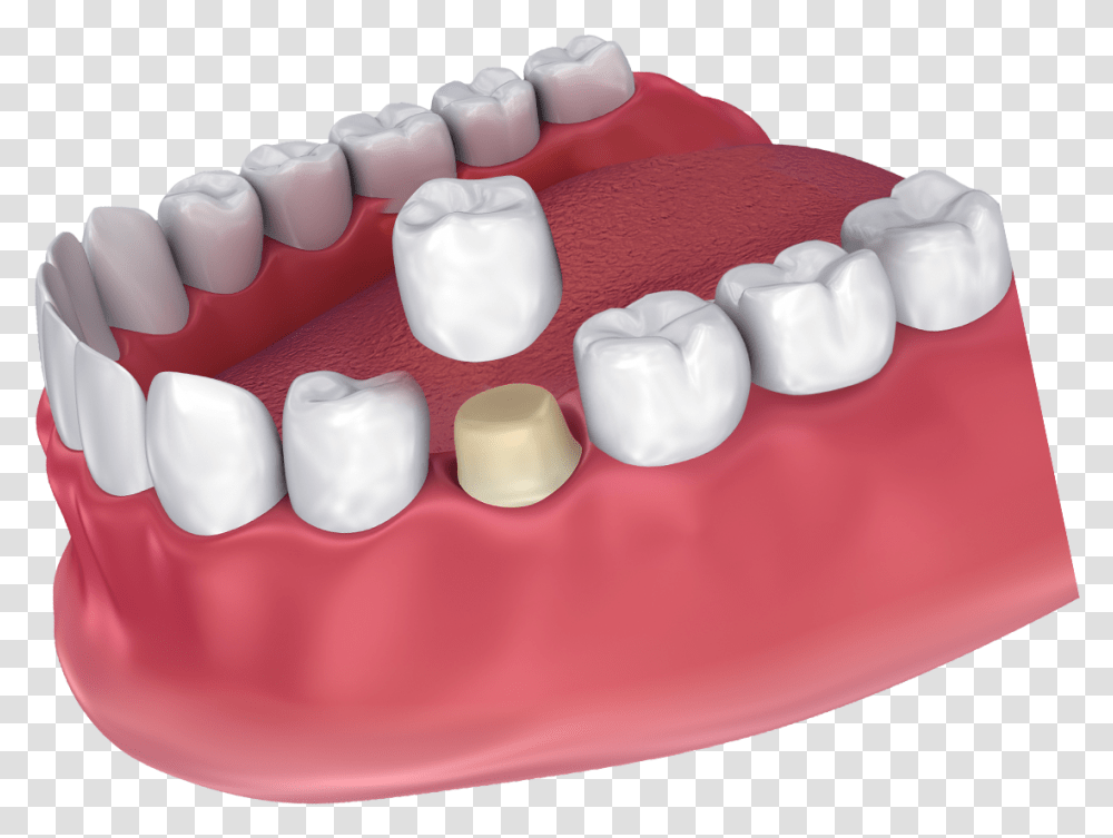 How A Dental Crown Fits Crown Dental, Teeth, Mouth, Lip, Birthday Cake Transparent Png